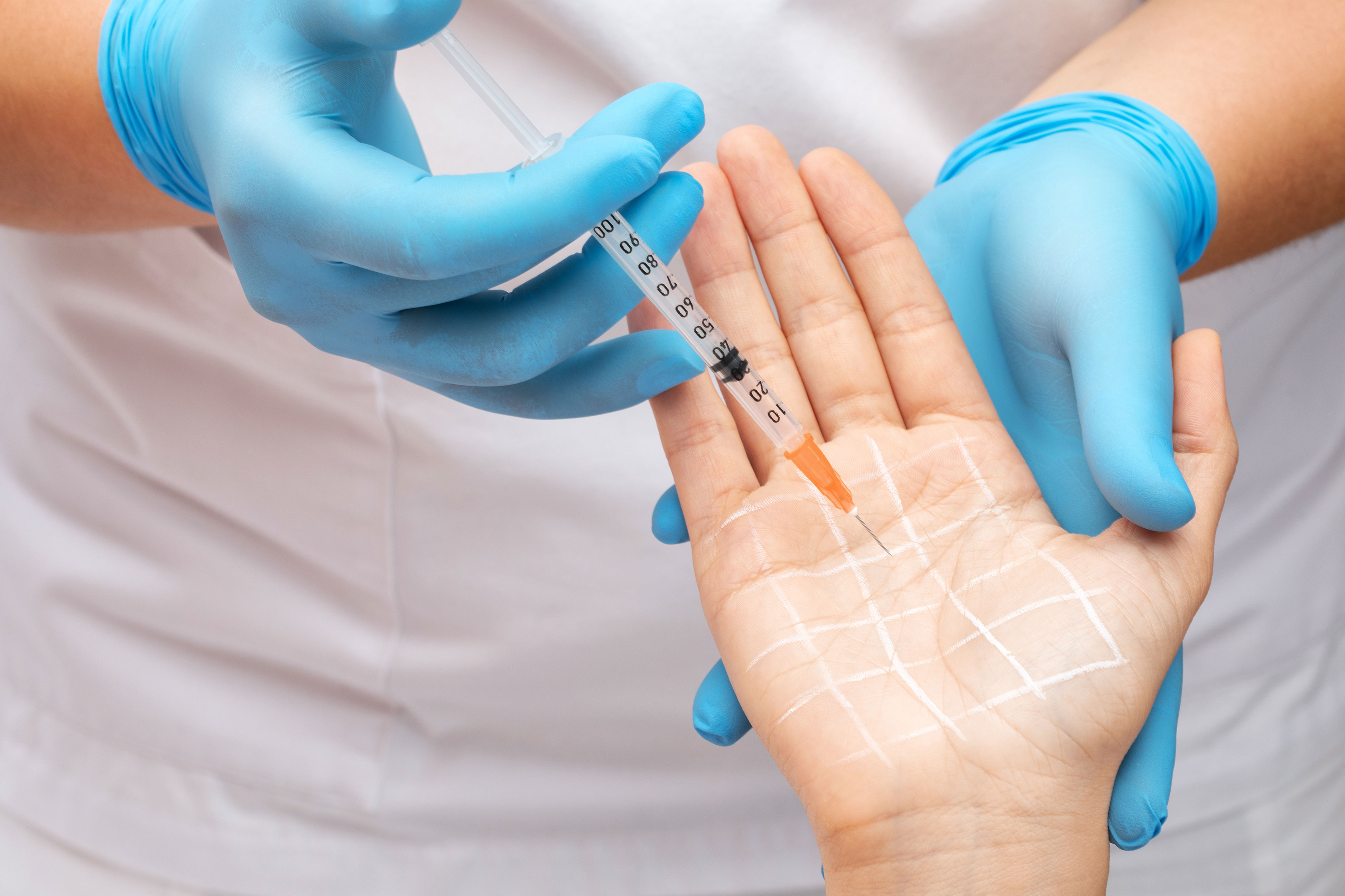 Botulinumtoxin Behandlung Hand 3980